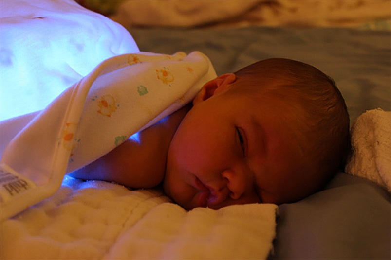 light treatment for babies with jaundice