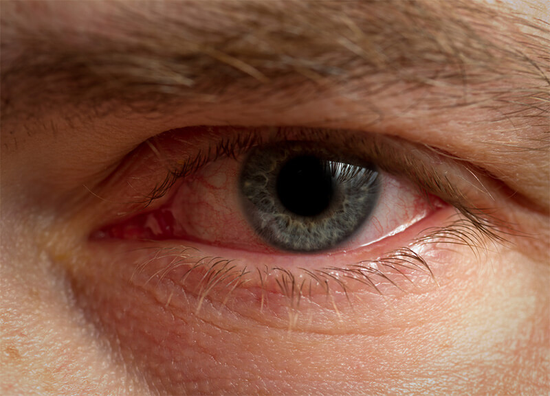 cause for ocular rosacea