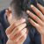 Androgenetic Alopecia in Older People: Understanding Hair Loss as We Age