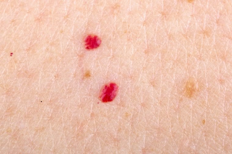 how to get rid of cherry angiomas