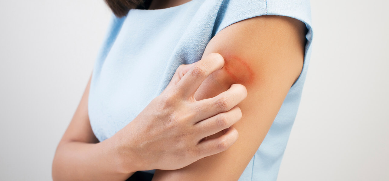ringworm treatments