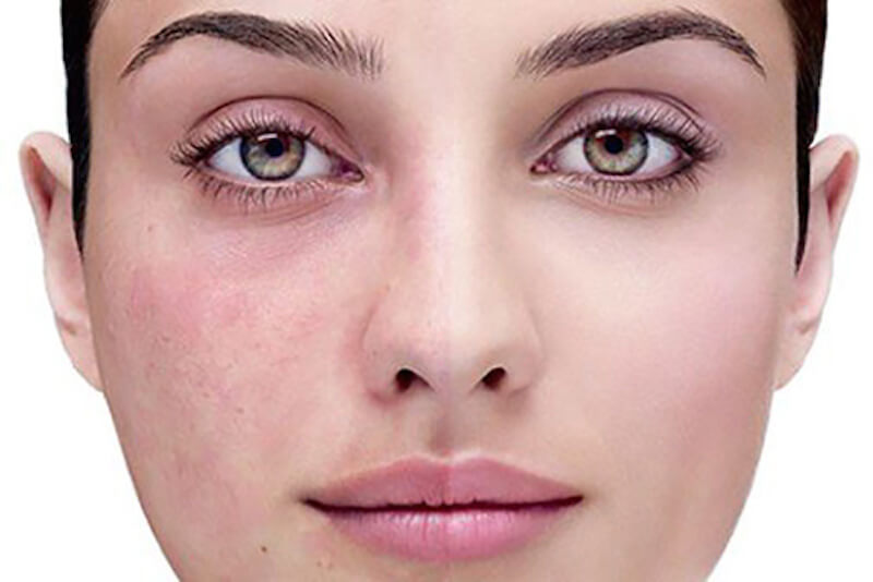 natural treatments for your rosacea that work