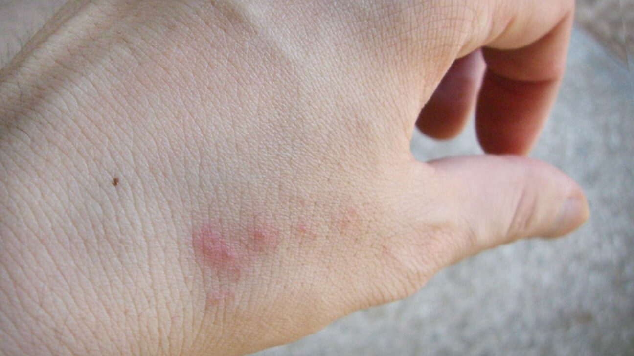 protect your skin from bed bugs