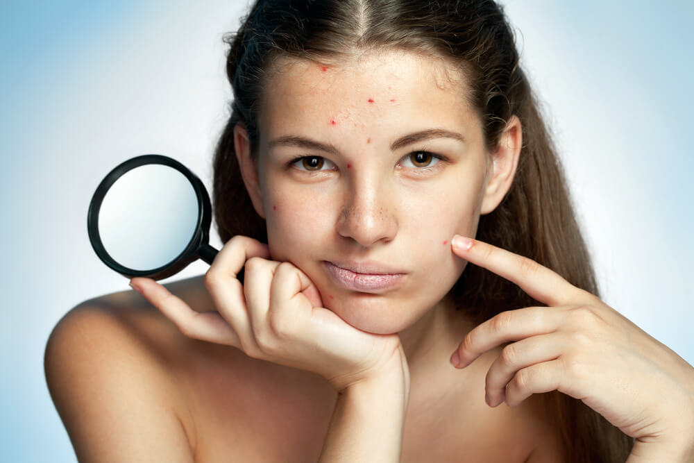 rosacea_ acne and how to treat it
