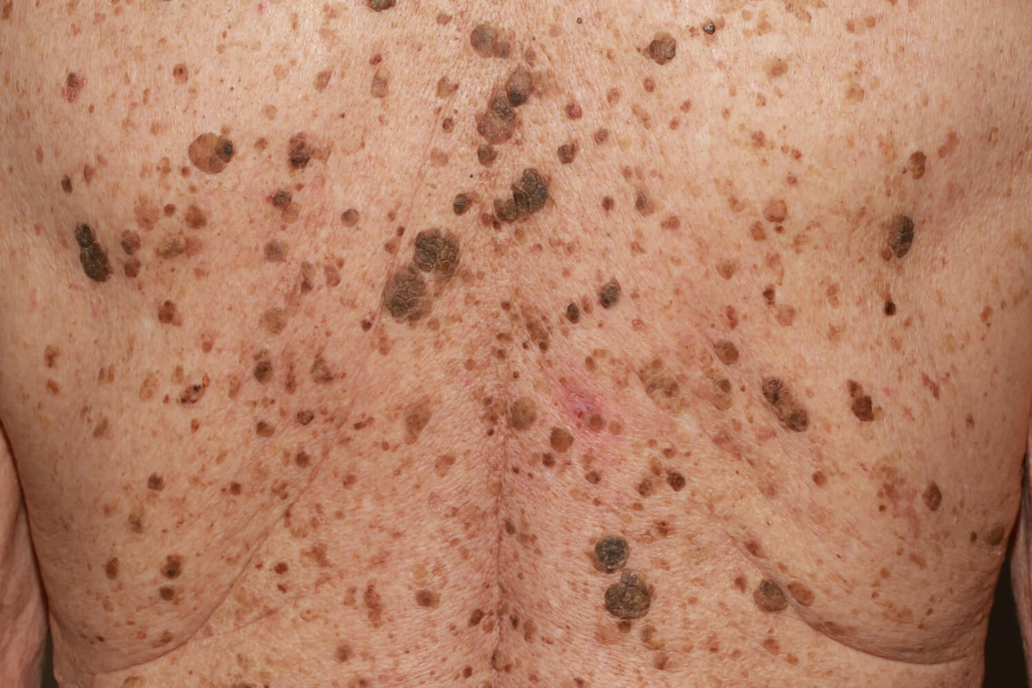 seborrheic-keratosis_image_2