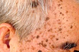 seborrheic-keratosis_image_3