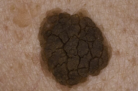 seborrheic-keratosis_image_zoom