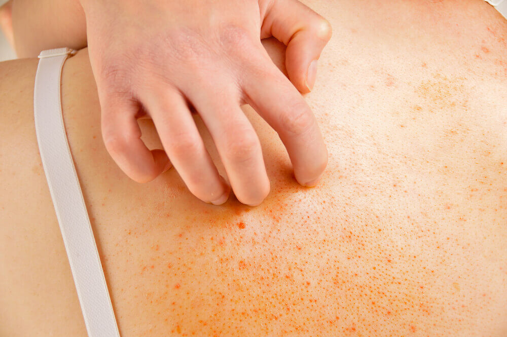 home remedies for skin irritation